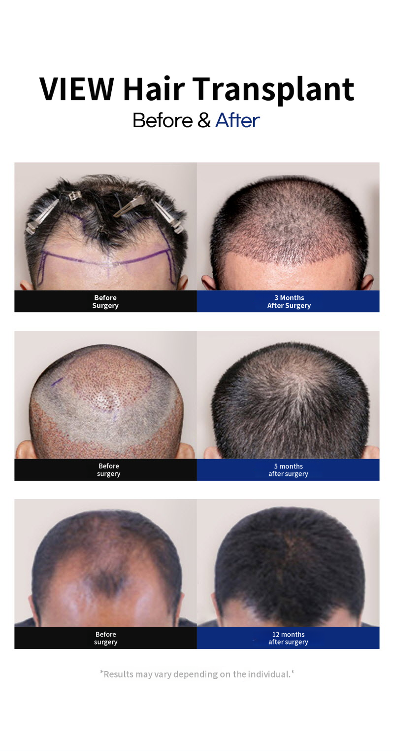 ❤View❤Hair Transplant