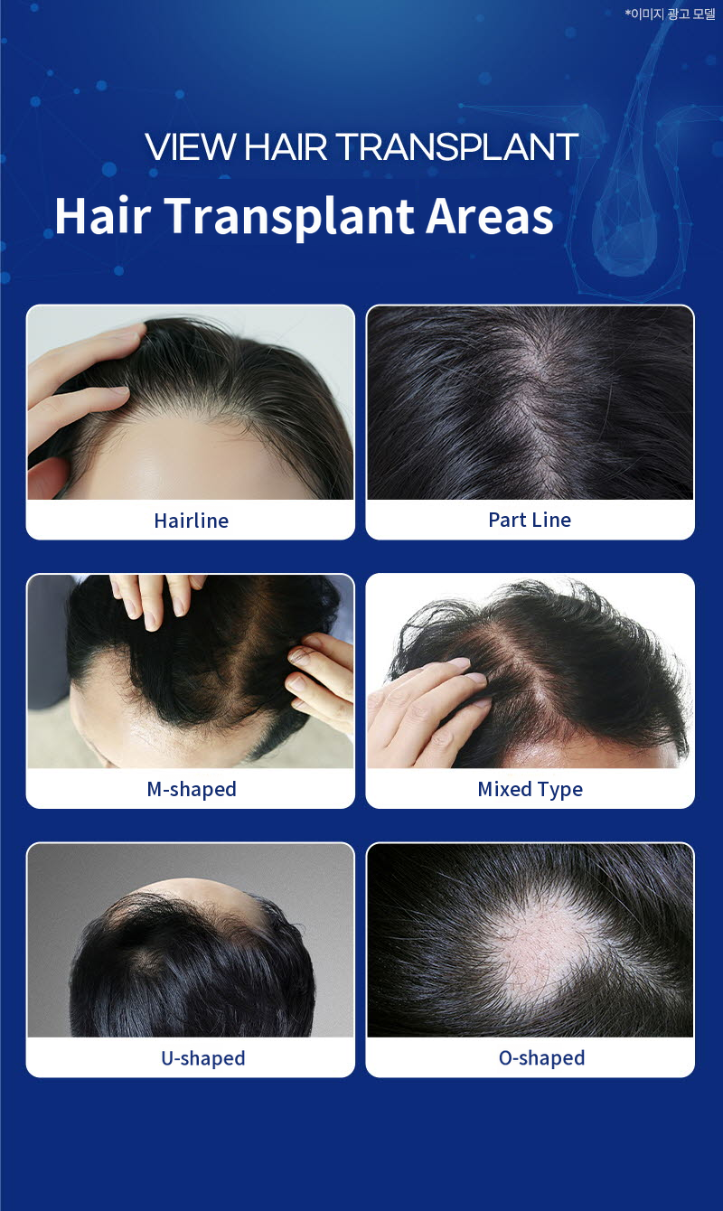 ❤View❤Hair Transplant