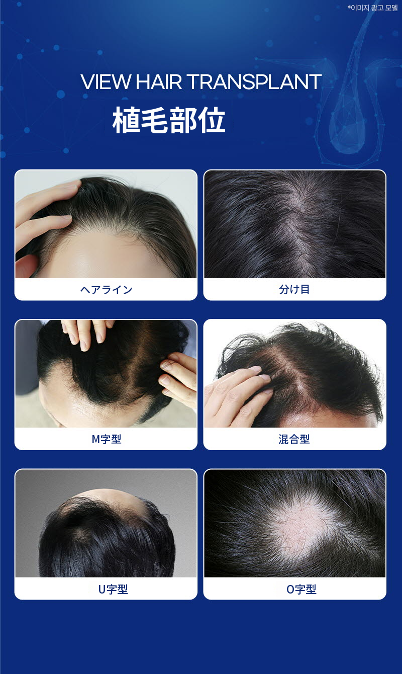 ❤ビュ❤毛髪移植