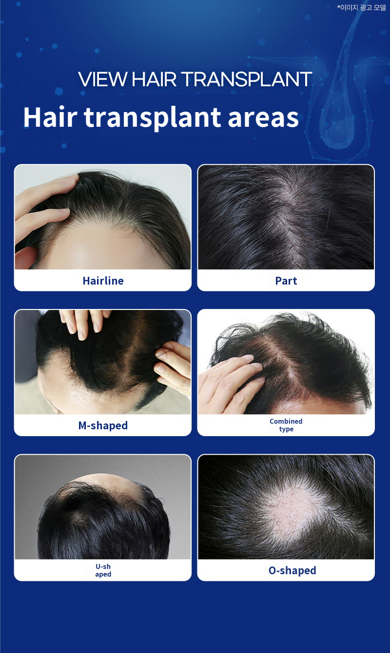 ❤View❤Hair Transplant