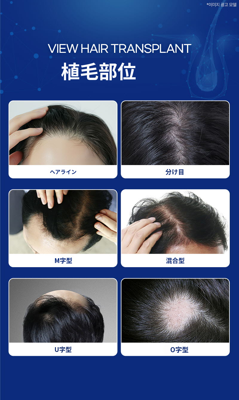 ❤ビュ❤毛髪移植