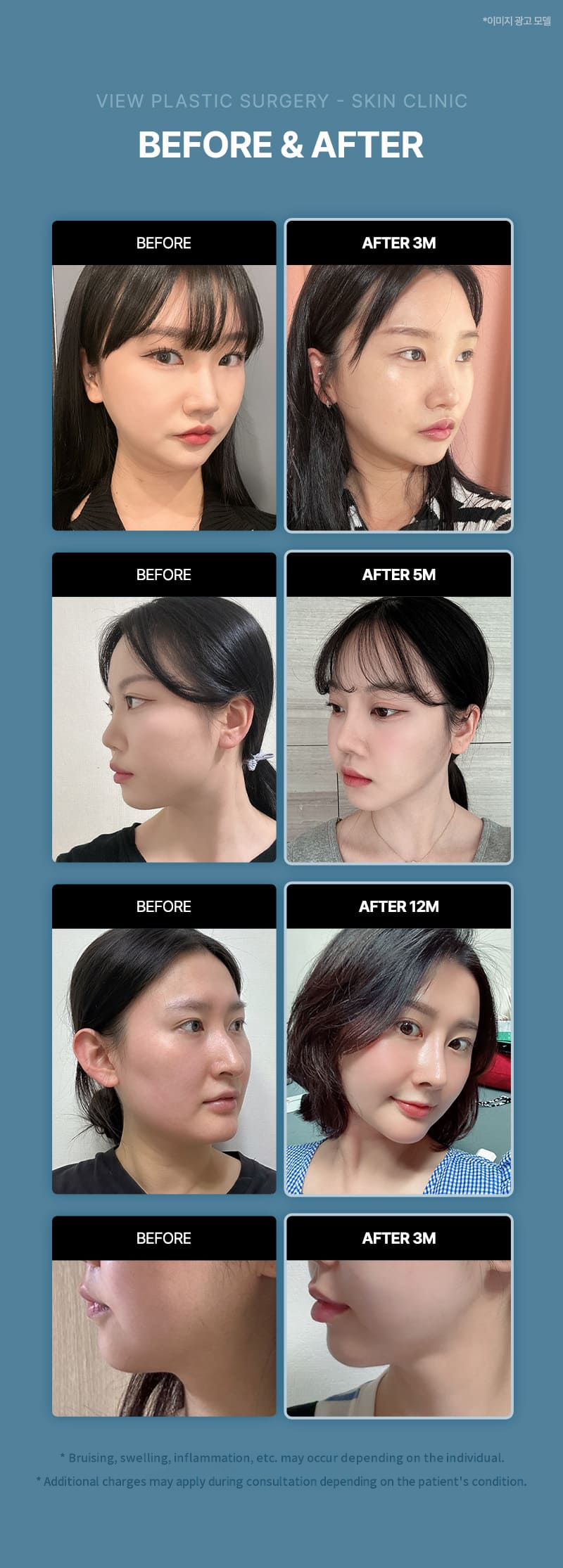 ❤View❤Contour Injection