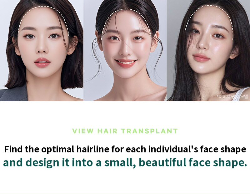 ❤View❤ Hairline Hair Transplant