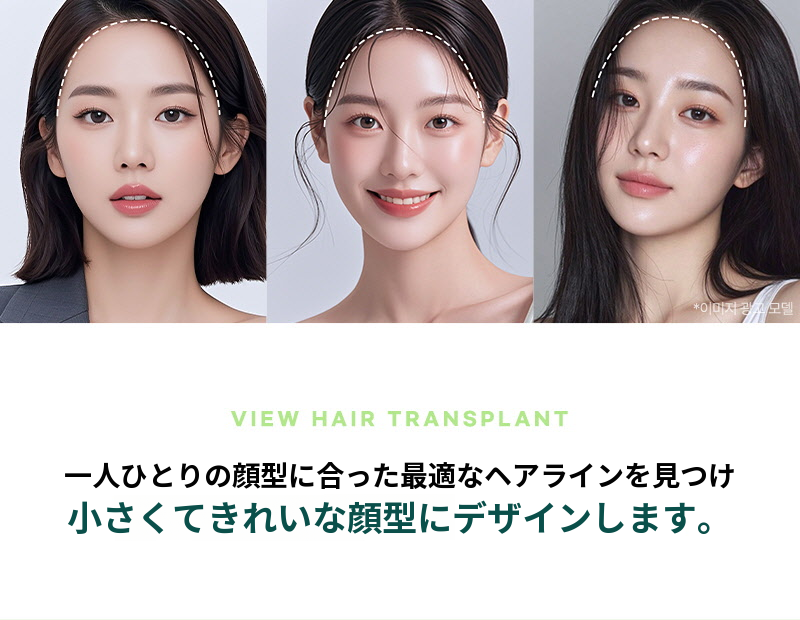 ❤ビュー❤ヘアラインの毛髪移植