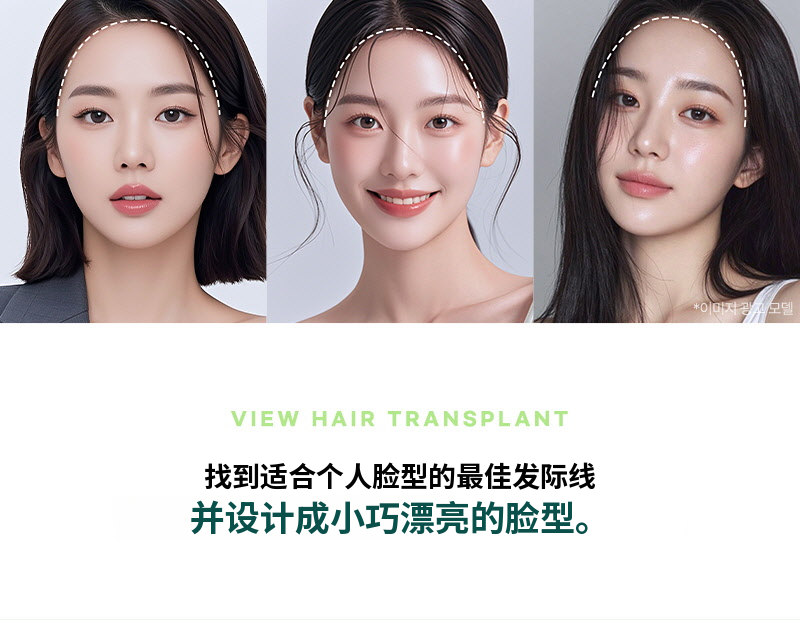 ❤视角❤发际线头发移植