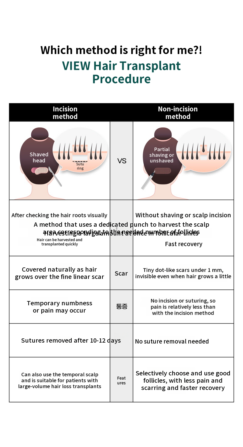 ❤View❤ Hairline Hair Transplant