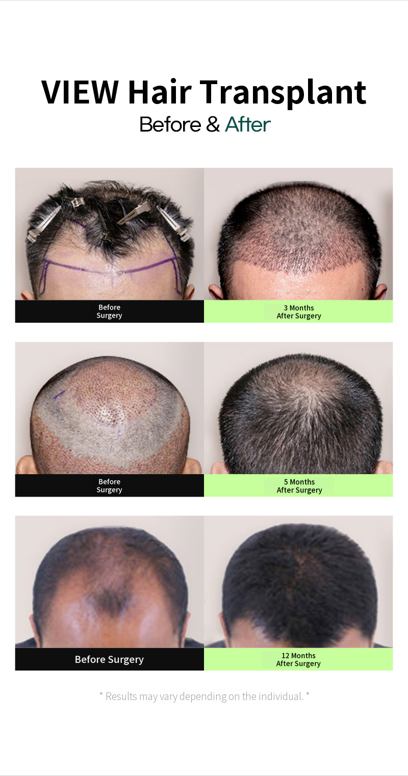 ❤View❤ Hairline Hair Transplant
