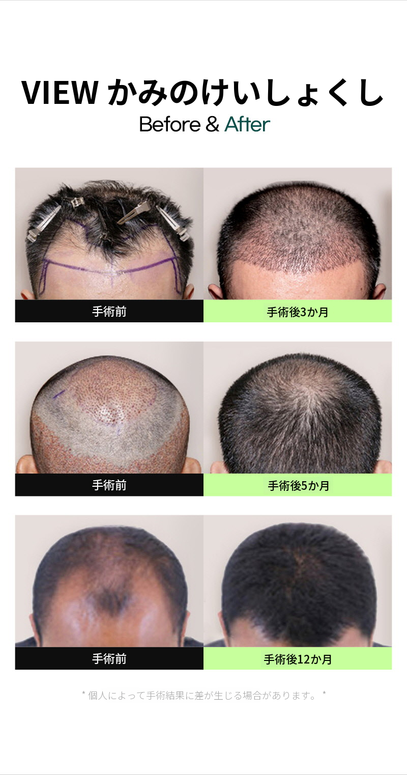 ❤ビュー❤ヘアラインの毛髪移植