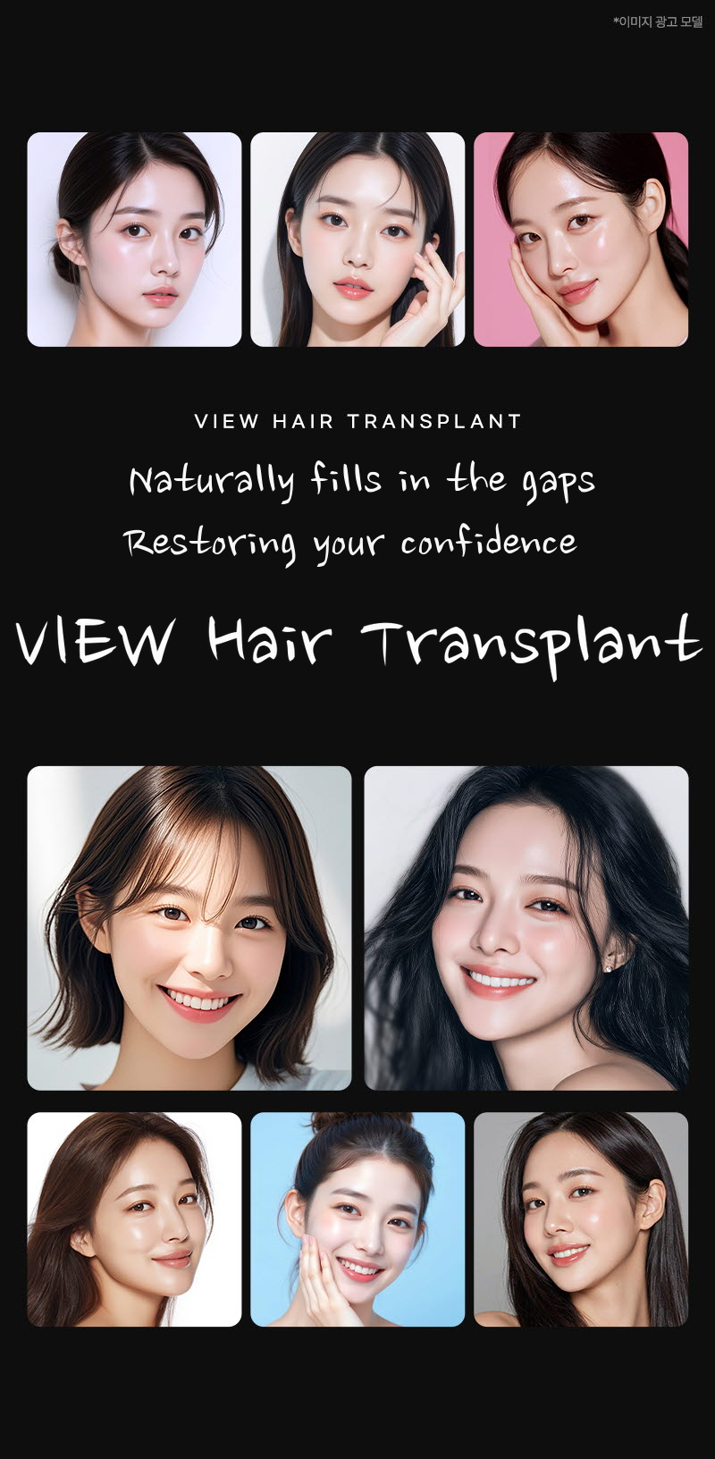 ❤View❤ Hairline Hair Transplant