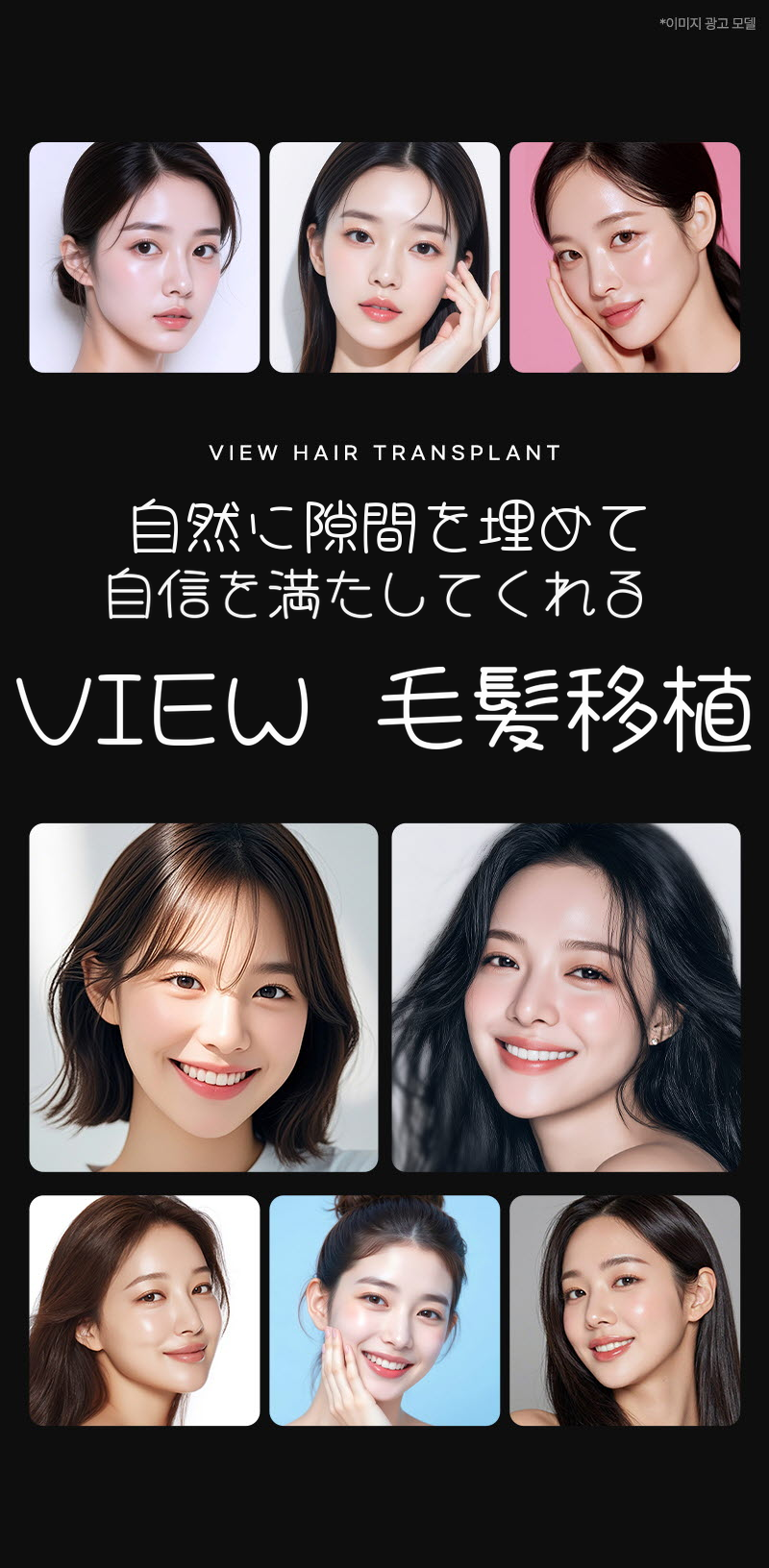 ❤ビュー❤ヘアラインの毛髪移植