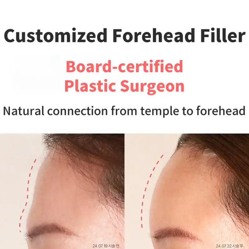 Customized Forehead Filler 4cc