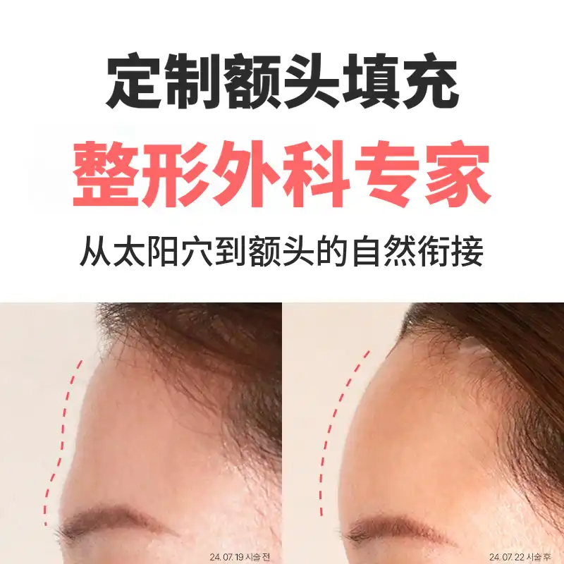 定制额头填充剂4cc