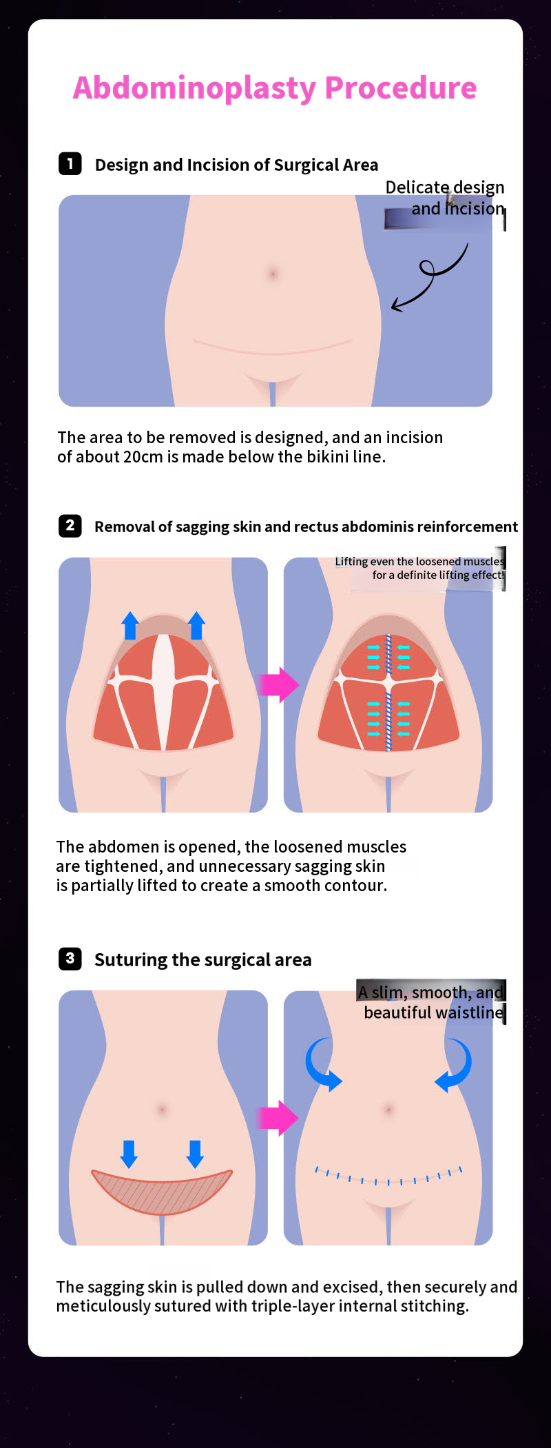 ❤ View ❤ Abdominoplasty