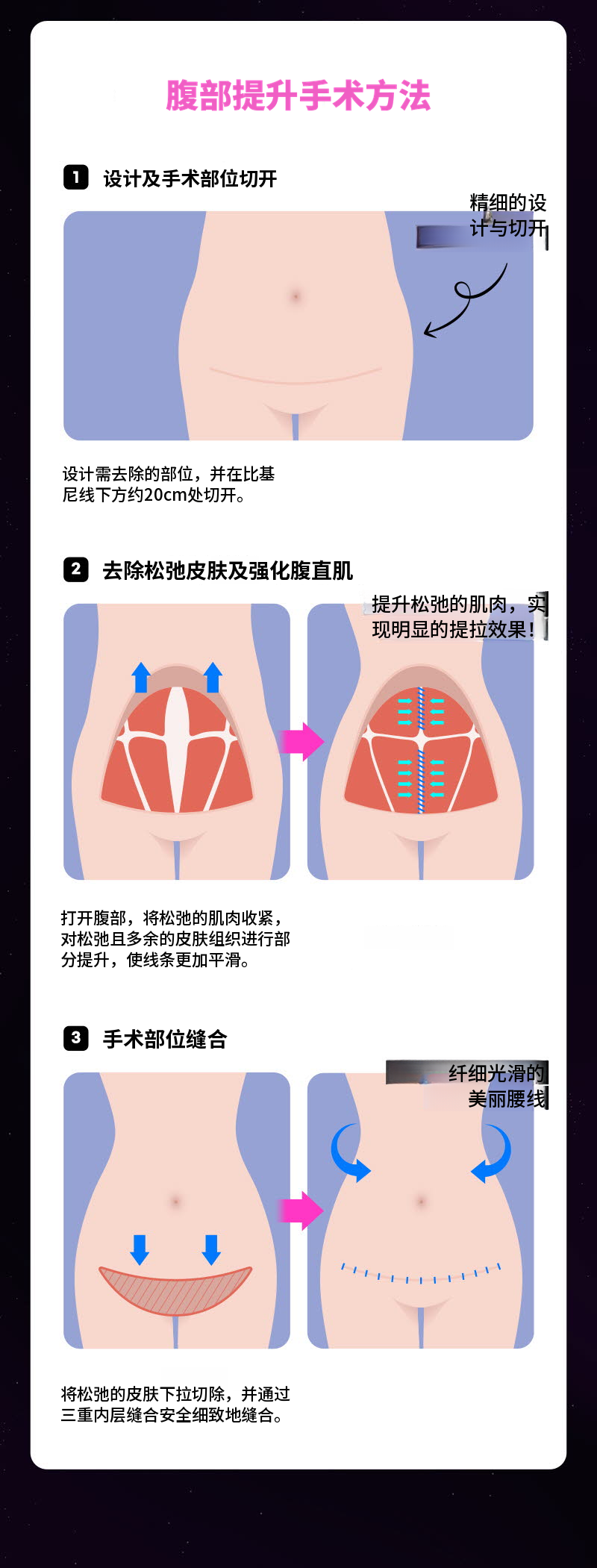 ❤美丽❤腹部提升术