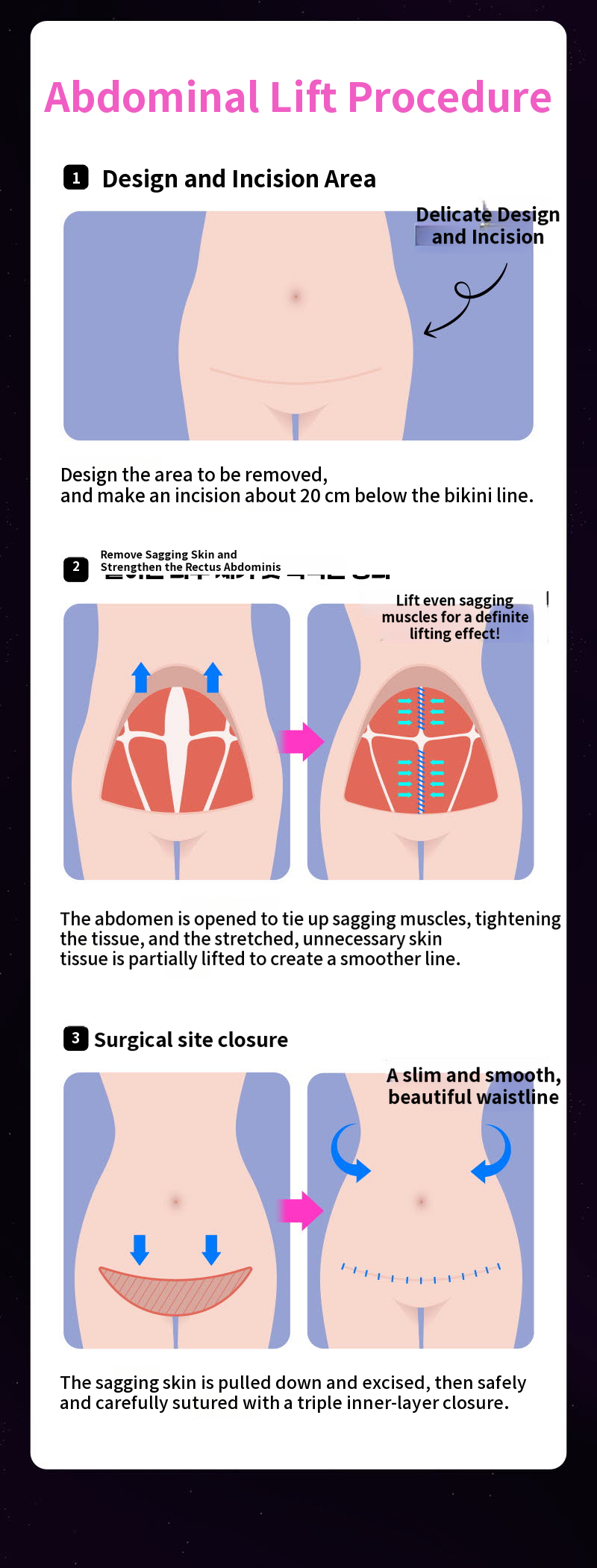 ❤View❤Abdominoplasty