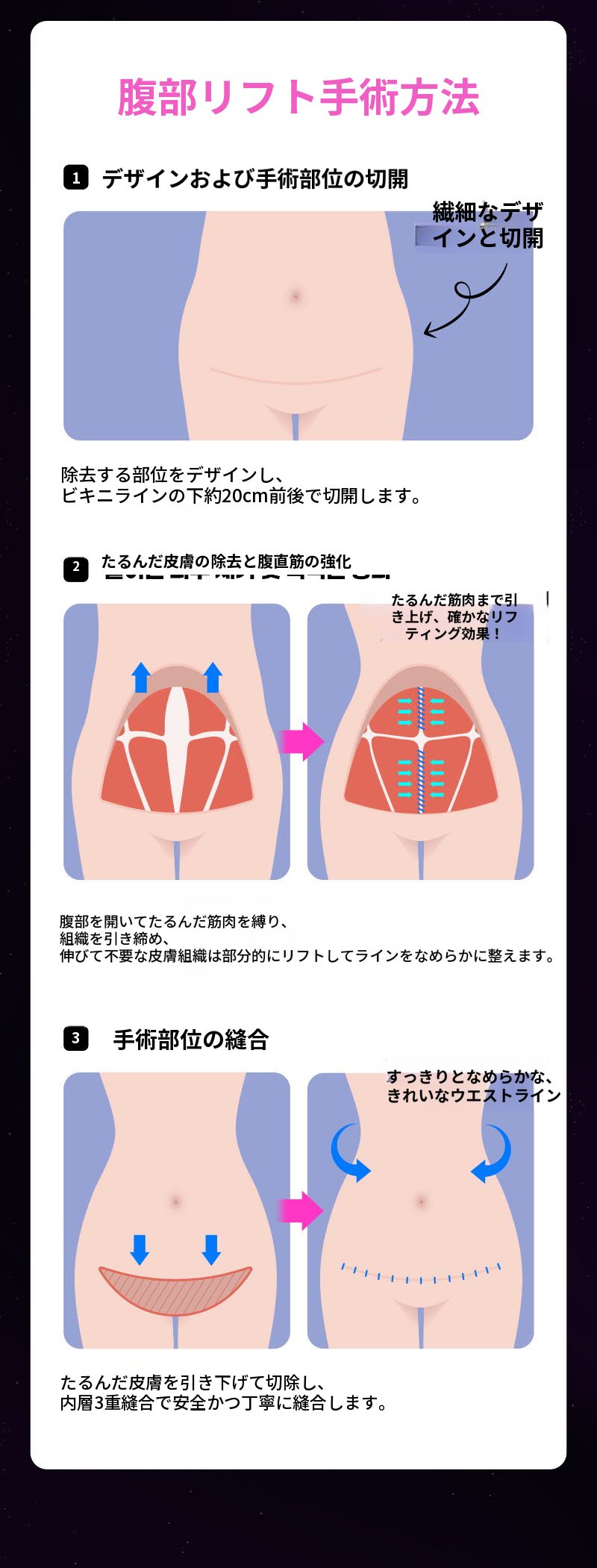 ❤ビュー❤腹部リフト術