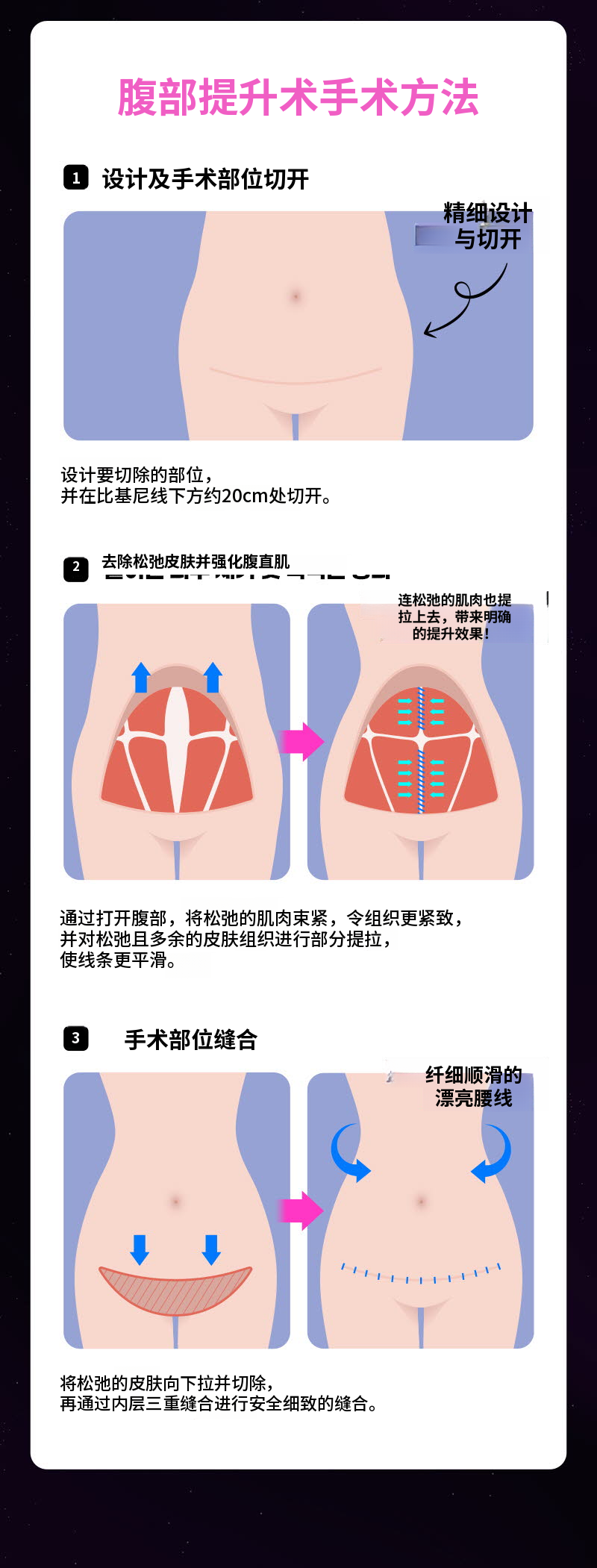 ❤视图❤腹部提升术