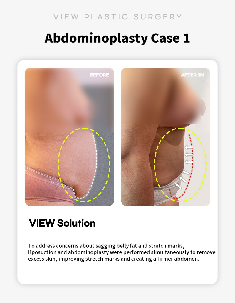 ❤ View ❤ Abdominoplasty