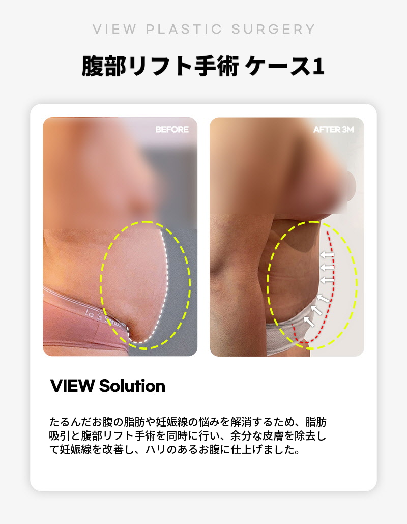 ❤ビュ❤腹部リフト術