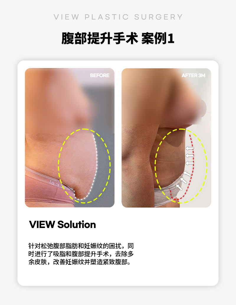 ❤美丽❤腹部提升术