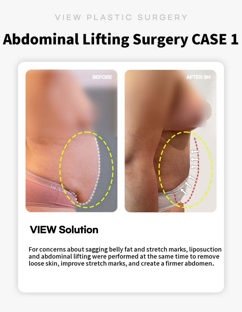 ❤View❤Abdominoplasty