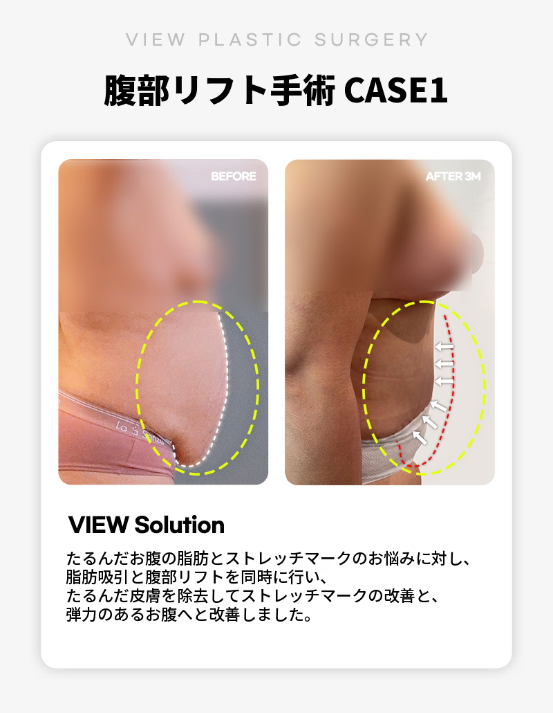 ❤ビュー❤腹部リフト術