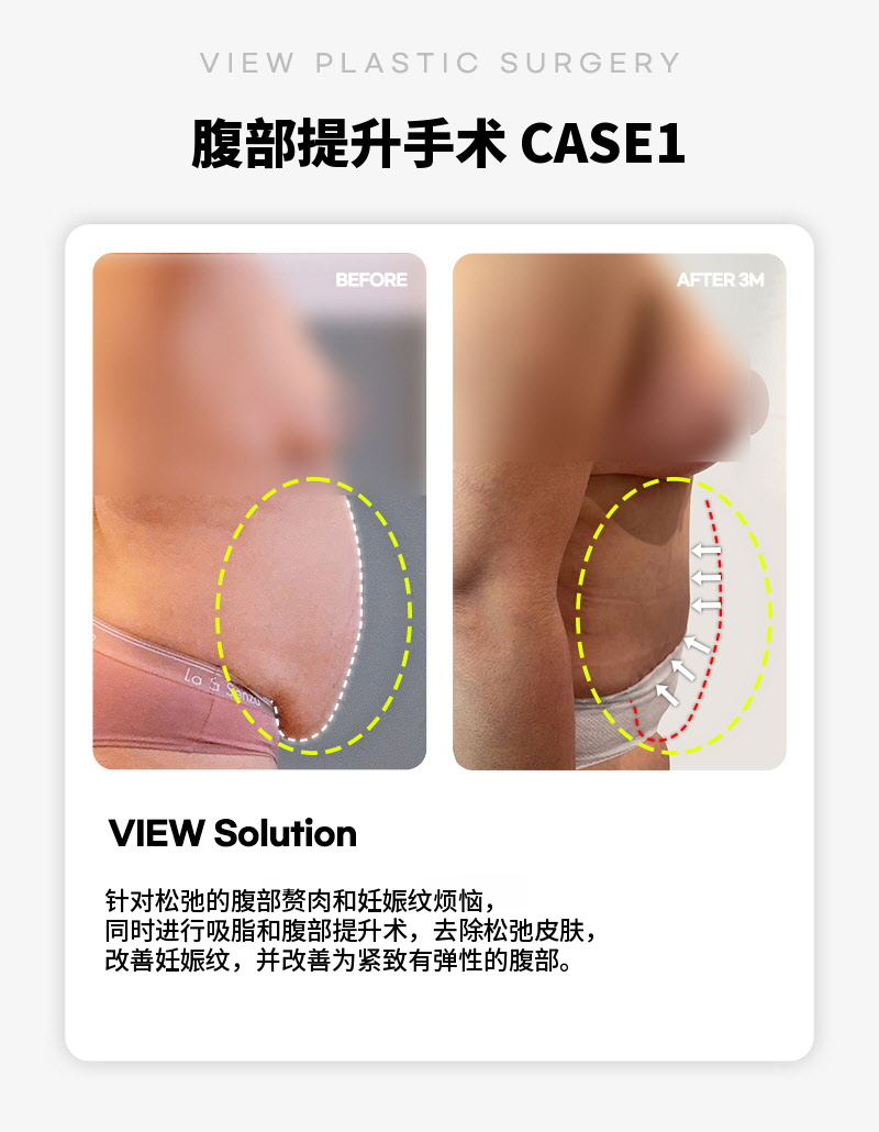 ❤视图❤腹部提升术