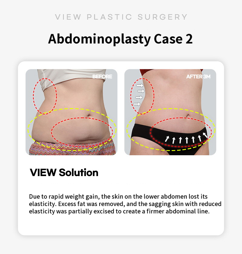 ❤ View ❤ Abdominoplasty