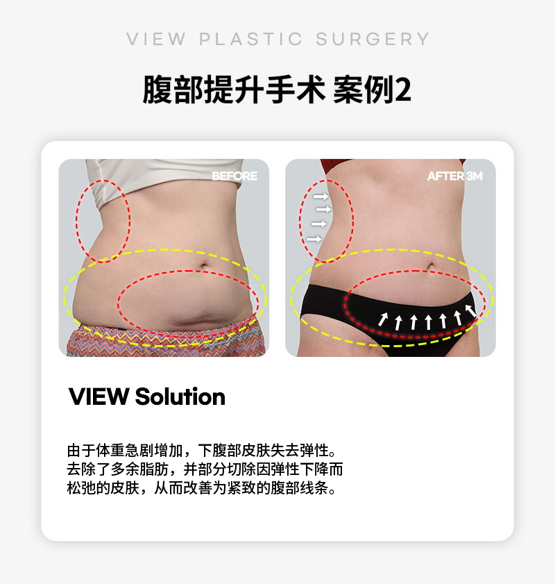 ❤美丽❤腹部提升术