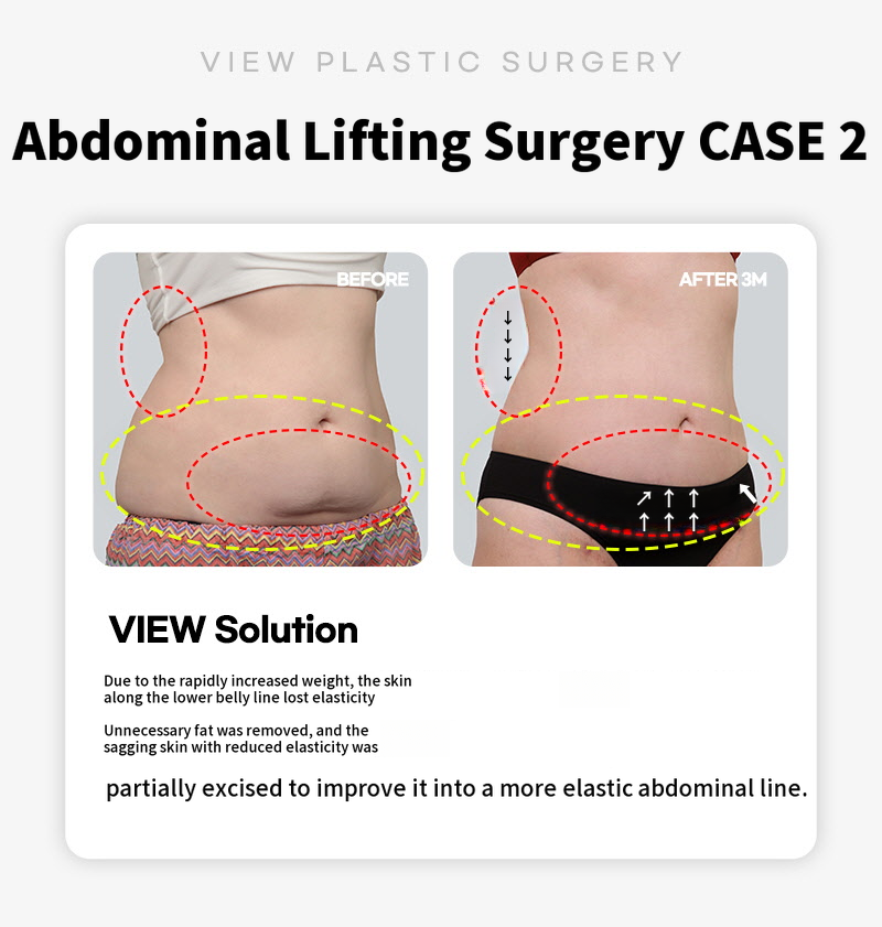 ❤View❤Abdominoplasty