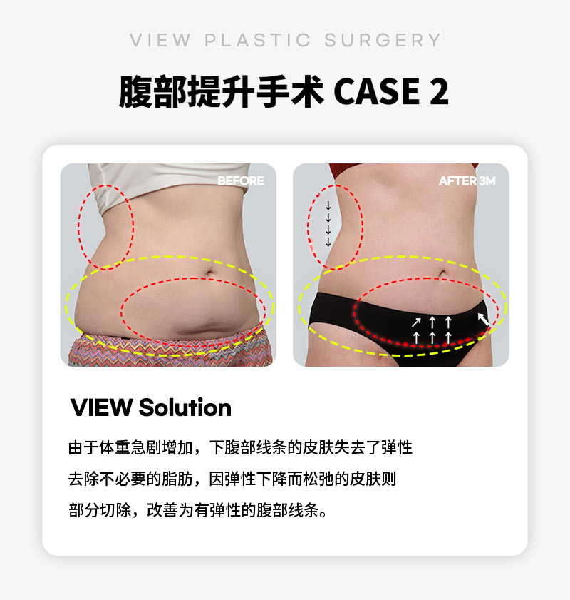 ❤视图❤腹部提升术
