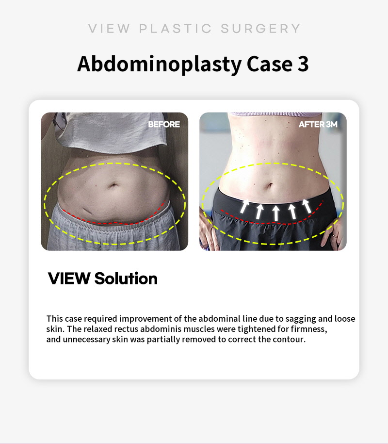 ❤ View ❤ Abdominoplasty