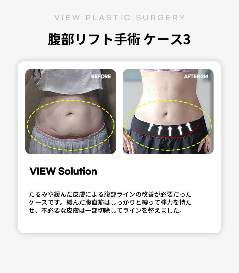 ❤ビュ❤腹部リフト術