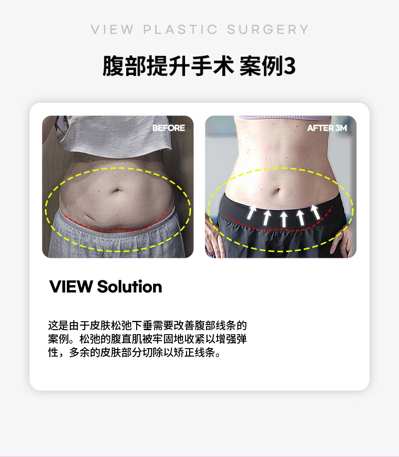 ❤美丽❤腹部提升术