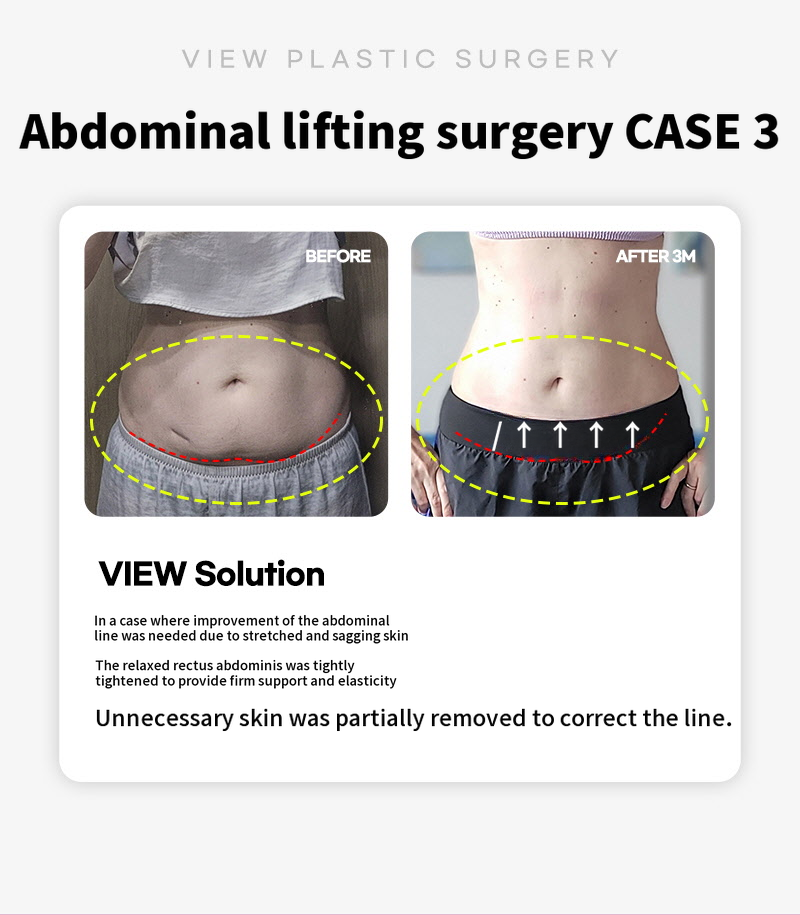 ❤View❤Abdominoplasty