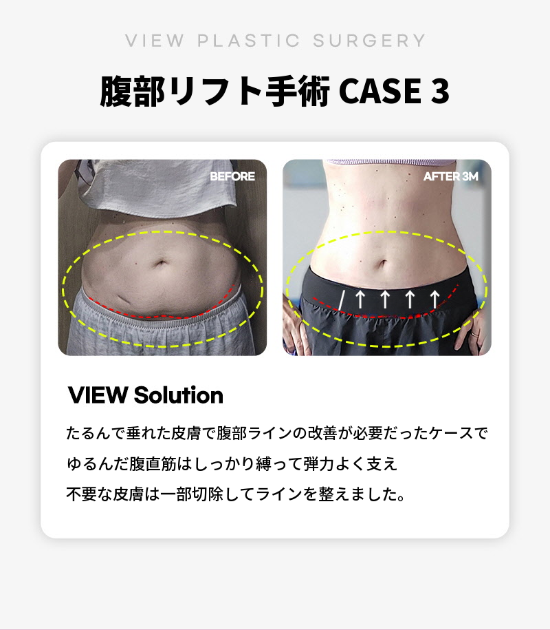 ❤ビュー❤腹部リフト術