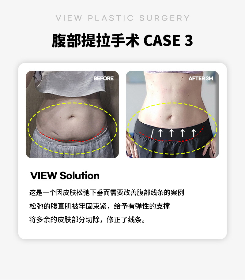 ❤视图❤腹部提升术