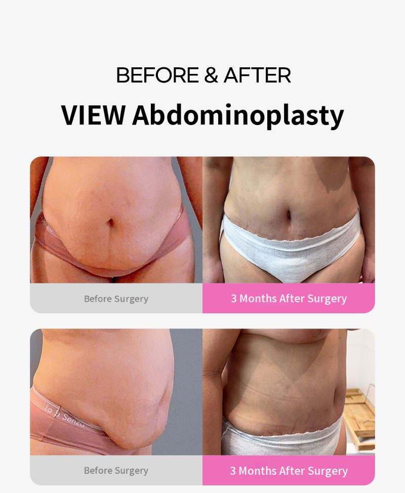 ❤ View ❤ Abdominoplasty