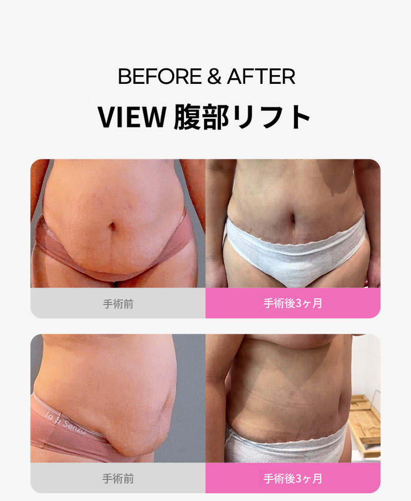 ❤ビュ❤腹部リフト術