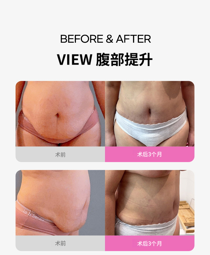 ❤美丽❤腹部提升术