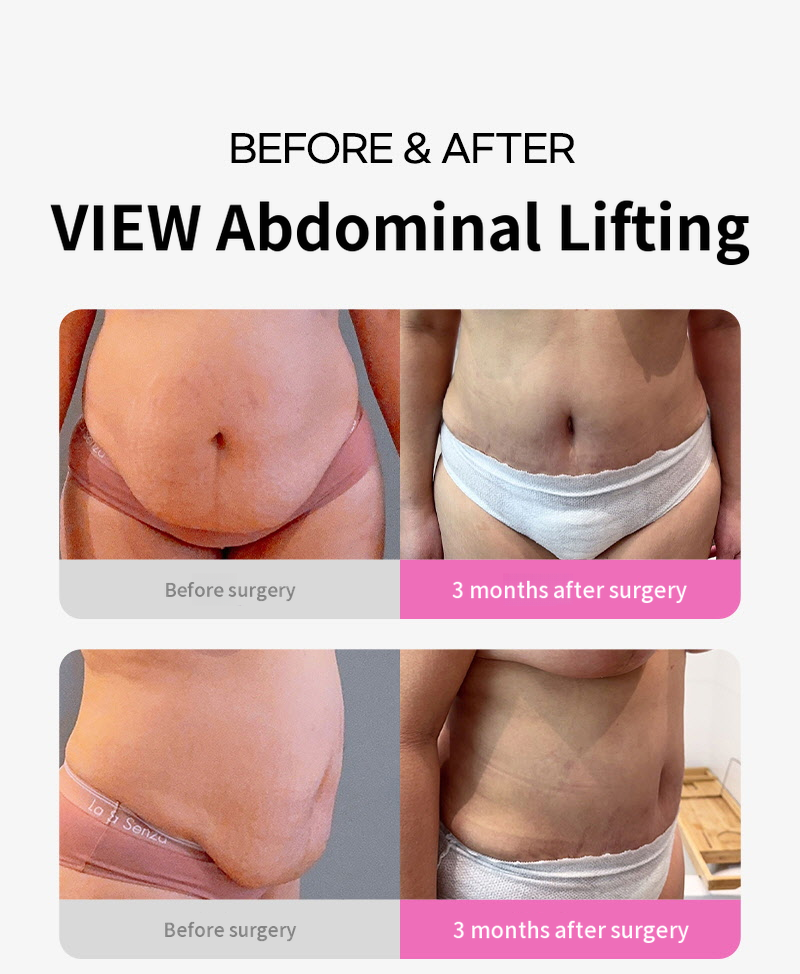 ❤View❤Abdominoplasty