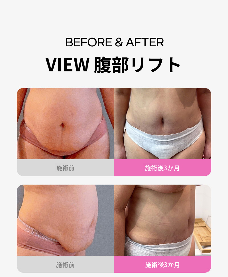 ❤ビュー❤腹部リフト術