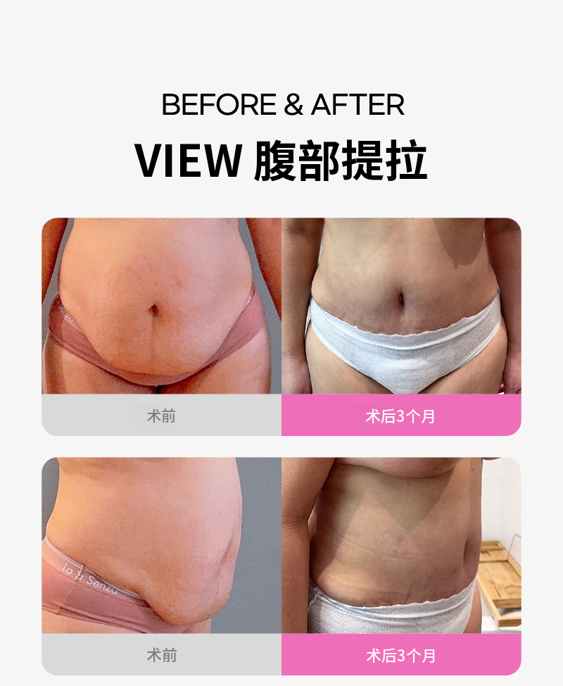 ❤视图❤腹部提升术
