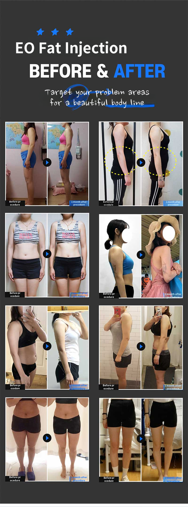 Steroid-free fat dissolving Iopatch injection
