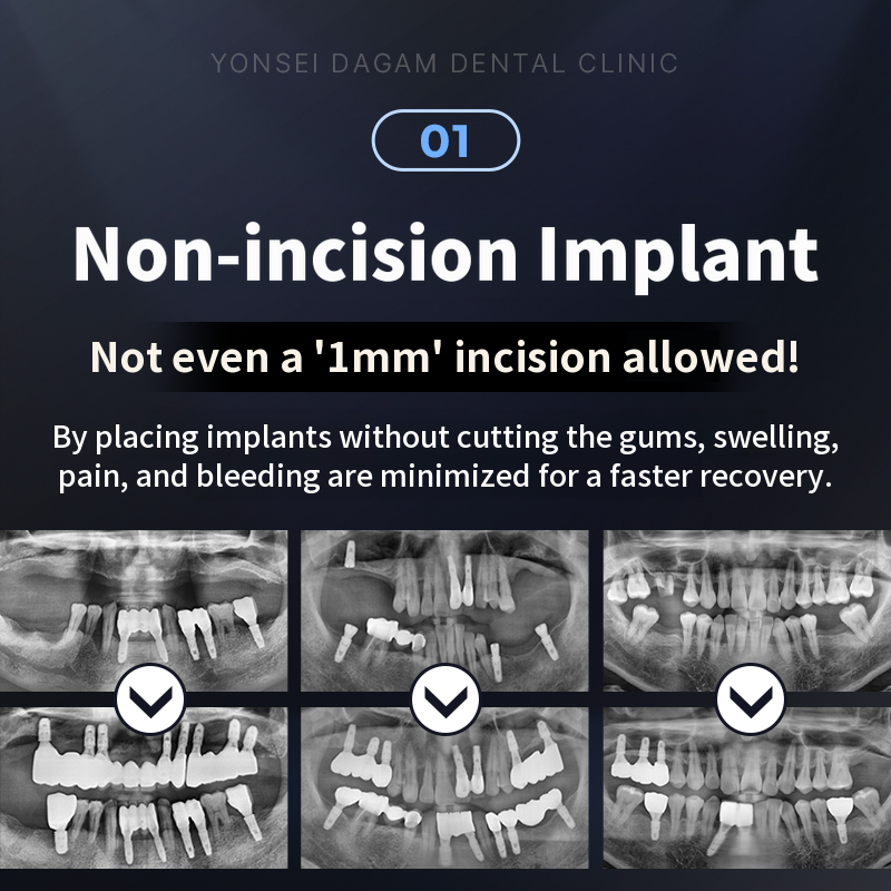Rapid return to daily life, minimally invasive implant