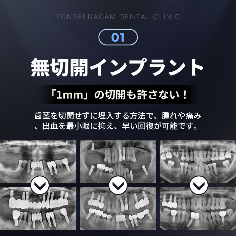 迅速な日常復帰、非侵襲的インプラント