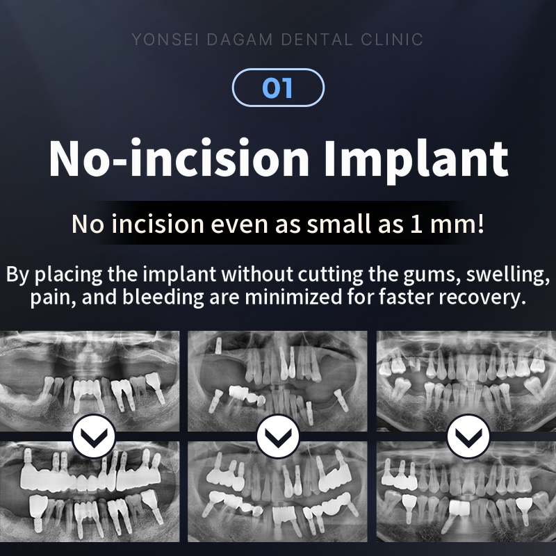 Quick return to daily life, non-invasive implants (Dentis)