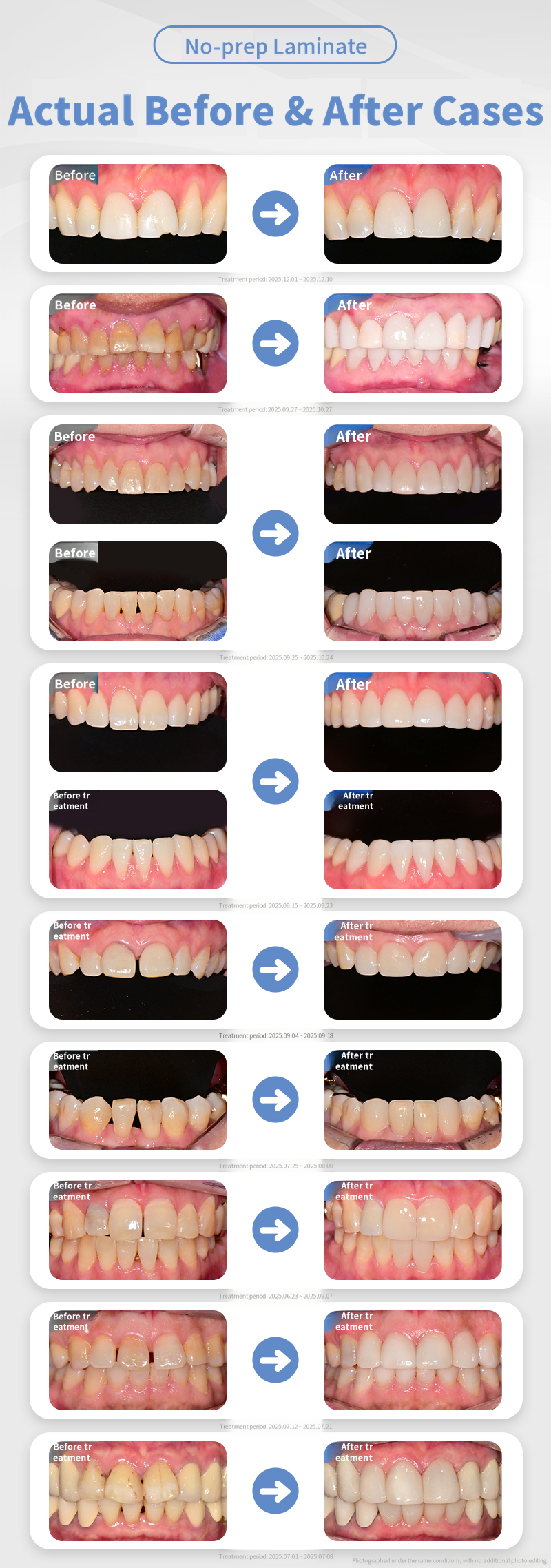 Non-invasive laminate without tooth damage