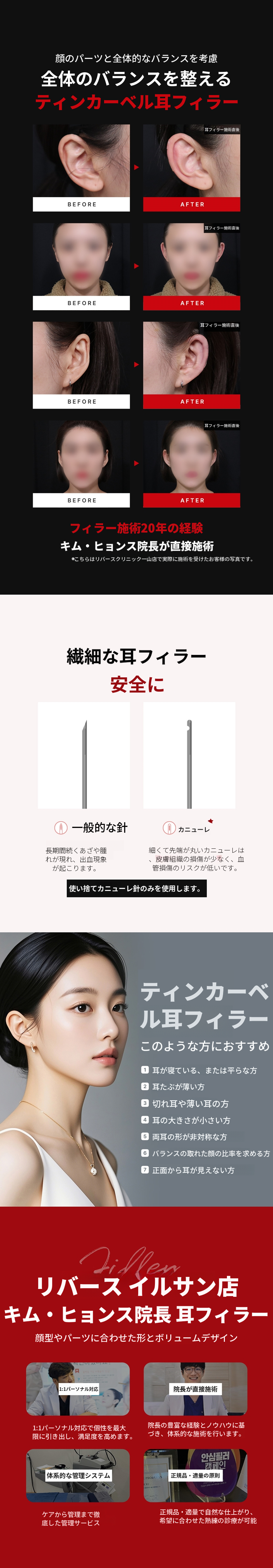 イルサン - 耳フィラーメイン施術