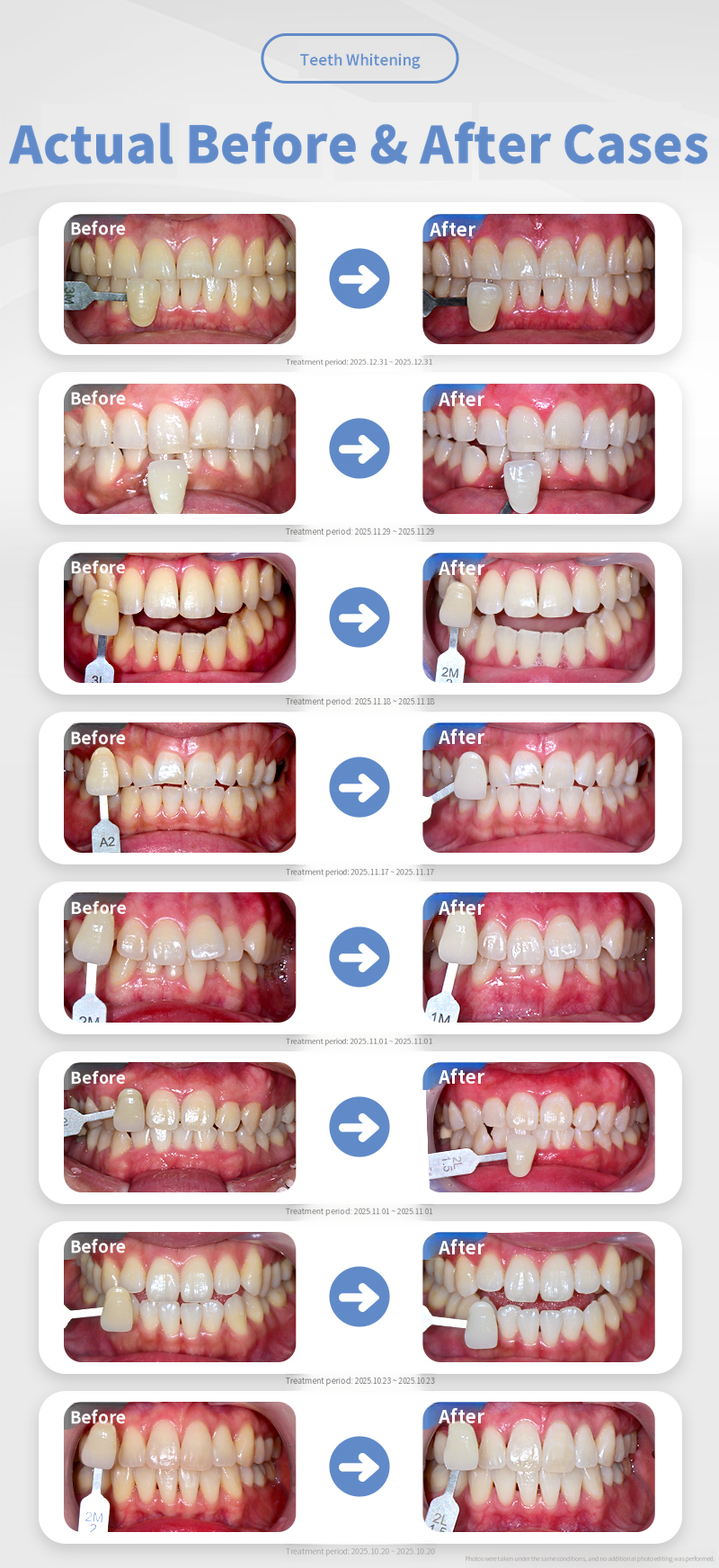 Whiten Again, Teeth Whitening / 2 Sessions Same Day